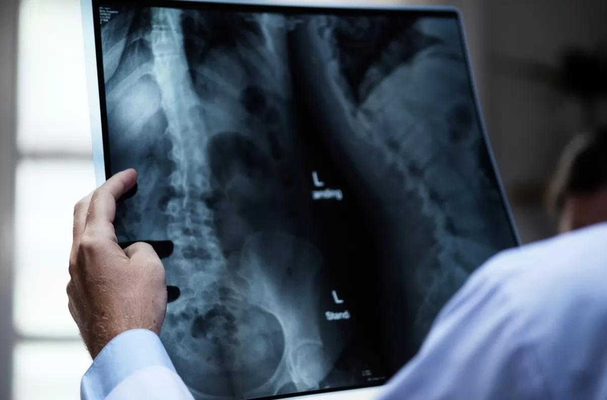 Omurga Kırığı Belirtileri ve Güncel Tedavi Yöntemleri