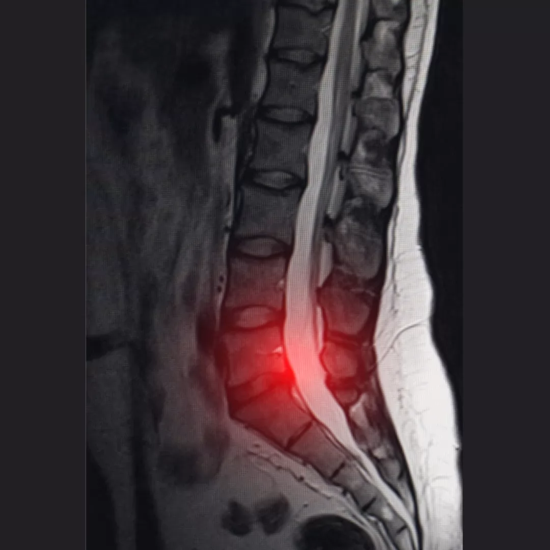 Herniated Disc